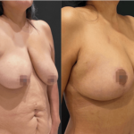 nps_funderberk-before-after-breast-lift-2-min
