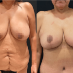 nps_funderberk-before-after-breast-lift-min