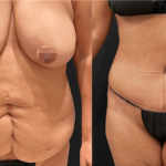 nps_funderberk-before-after-tummy-tuck-8.9-min