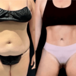 nps_funderberk-before-after-tummy-tuck-8.98-min