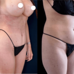 nps_funderberk-before-after-tummy-tuck-min