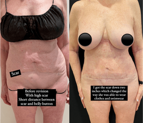 nps-tummy-tuck-revision-before-after-blog-min