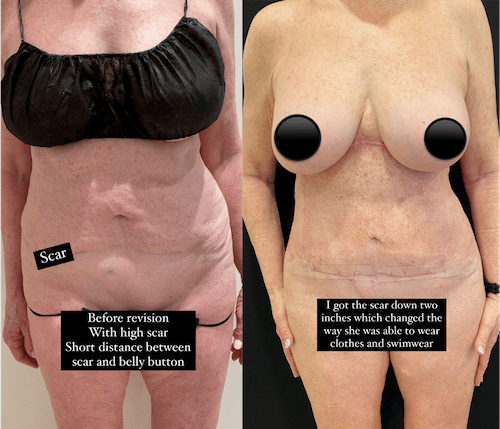 Patient 176763660  Tummy Tuck Revision by Dr. Booth Before