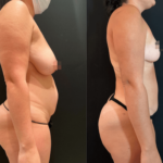 nps_before-after-breast-lift-9.26-min copy