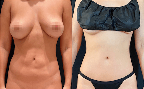 nps_before-after-coolsculpting-revision-9.28-min