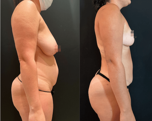 nps_before-after-mommy-makeover-9.26-min
