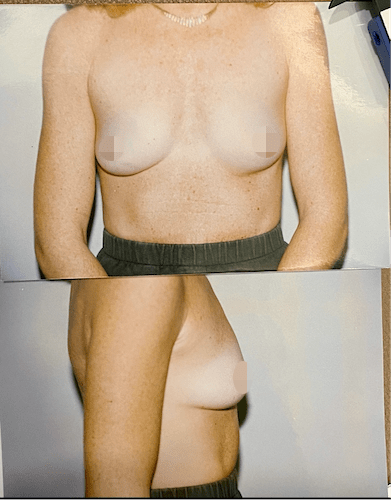 breast-implant-blog-1-min