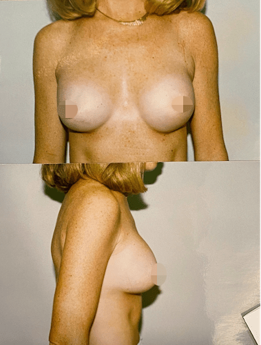 breast-implant-blog-2-min