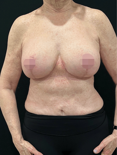 breast-implant-blog-4-min