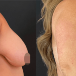 nps_before-after-breast-lift