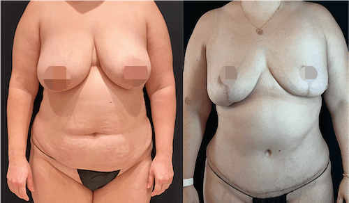 nps_before-after-tummy-tuck-mommy-makeover-2-min