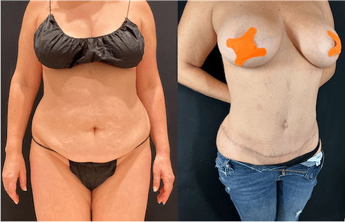 nps_before-after-tummy-tuck-mommy-makeover-min
