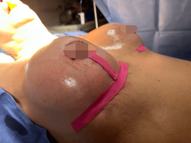 nps_breast-revision-case-6
