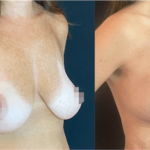 NPS_before-after-breast-lift-11.14-2png-min