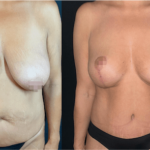 NPS_before-after-breast-lift-11.14-min