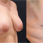 NPS_before-after-breast-reduction-11.14-min