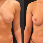 nps_arms-before-after-breast-profile-7