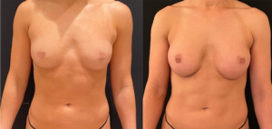 nps_arms-before-after-breast-profile-7