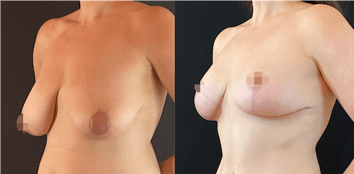 nps_before-after-breast-lift-11-min