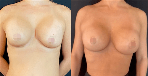 nps_before-after-breast-revision-min