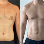 nps_before-after-male-lipo-360-11.4-min