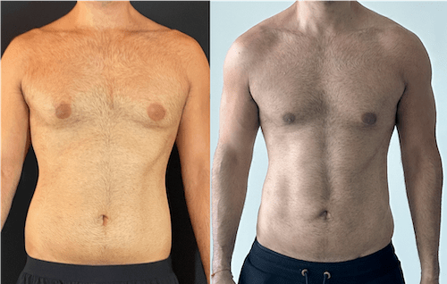Liposuction for Men Before & After Photo Gallery