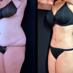 NYC mother of 5, Lipo360, multi-vector muscle repair, extended tummy tuck