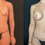 nps_before-after-mommy-makeover-11.25-2-min