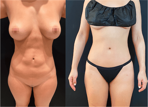 CoolSculpting vs. Liposuction: Cost, Side Effects, Pictures, More