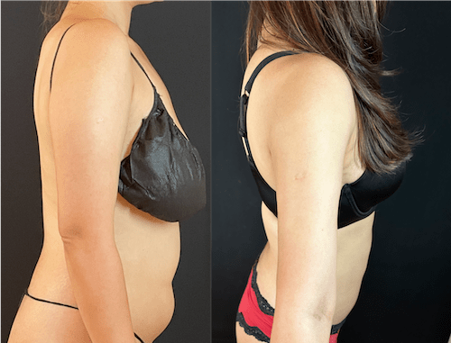 nps_before-afer-arm-lipo