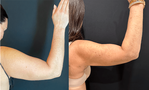 nps_before-after-arm-lipo