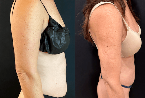nps_before-after-arm-lipo