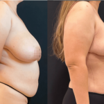 nps_before-after-breast-reduction-12-1-2-min