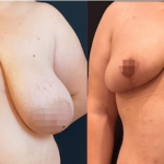 nps_before-after-breast-reduction-12-1-min