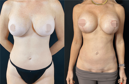 nps_before-after-mommy-makeover-3-12-min