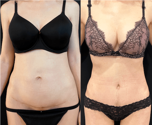 nps_before-after-revision-tummy-tuck