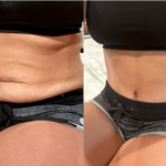 nps_before-after-tummy-tuck-12.27-min