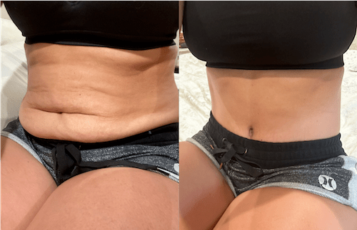 nps_before-after-tummy-tuck-12.27-min
