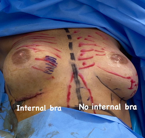 nps_revision-breast-surgery-case-11.2