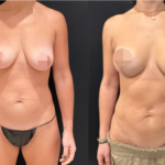 nps_before-after-breast-lift-with-implants-1-min