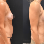 nps_before-after-breast-lift-with-implants-2-min