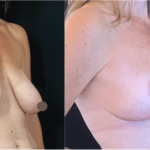 nps_breast-lift-before-after-min