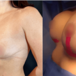nps_breast-lift-implants-before-after-min