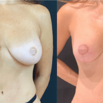 nps_breast-revision-before-after-1.3-min