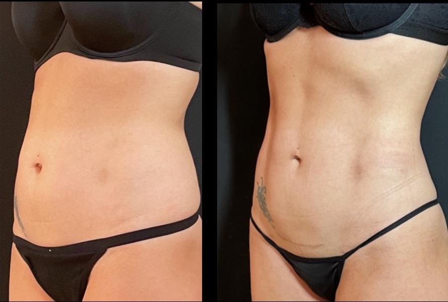 Liposuction vs Tummy Tuck - Neinstein Plastic Surgery