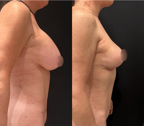 Breast Implant Removal Surgery - Neinstein Plastic Surgery