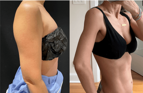 nps_before-after-arm-3.20-min