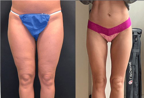nps_before-after-thigh-lipo-2-3.20-min