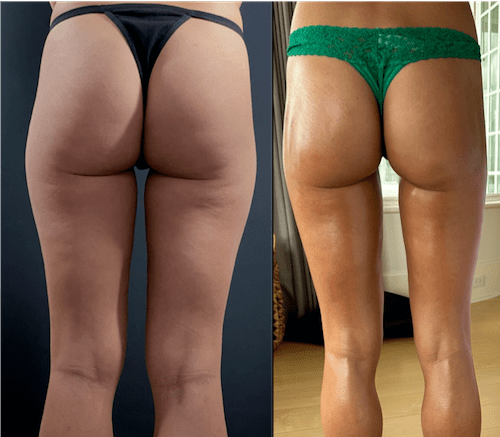 nps_before-after-thigh-lipo-3.20-min