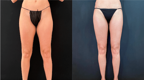 nps_before-after-thighs-min